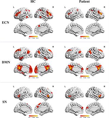 Disrupted Brain Intrinsic Networks and Executive Dysfunction in Cirrhotic Patients without Overt Hepatic Encephalopathy